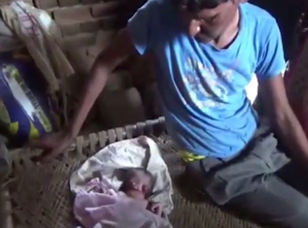 Baby born with facial deformities at Aligarh in Uttar Pradesh
