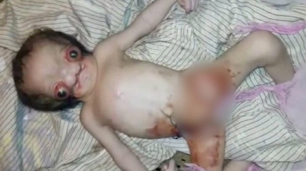 Baby born with facial deformities at Aligarh in Uttar Pradesh