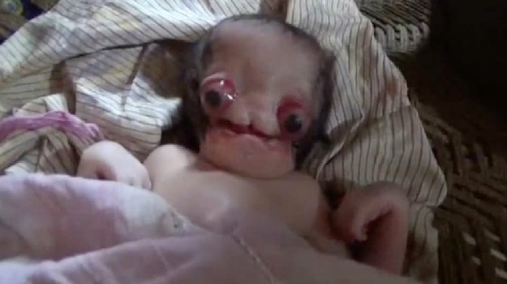 Baby born with facial deformities at Aligarh in Uttar Pradesh
