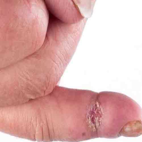 JAY VIRDEE suffering from SCLERODERMA with lots of pain