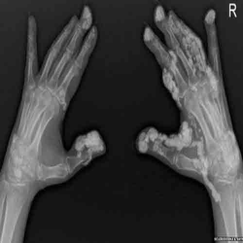 JAY VIRDEE suffering from SCLERODERMA with lots of pain