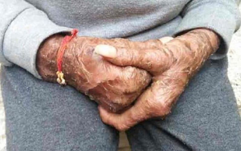 Indian snake girl suffering from rare skin disease 