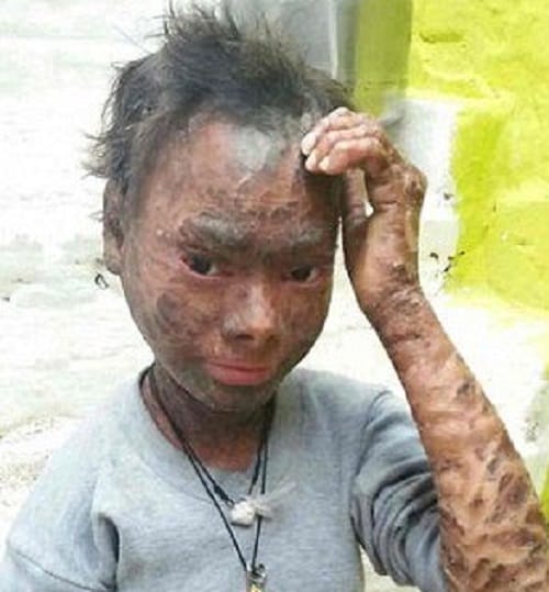 Indian snake girl suffering from rare skin disease 