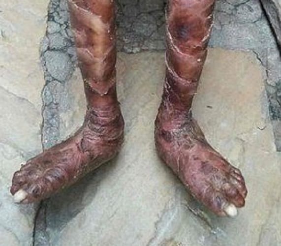 Indian snake girl suffering from rare skin disease 
