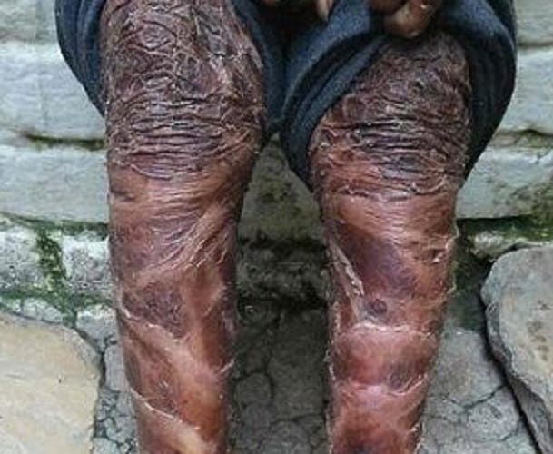 Indian snake girl suffering from rare skin disease 
