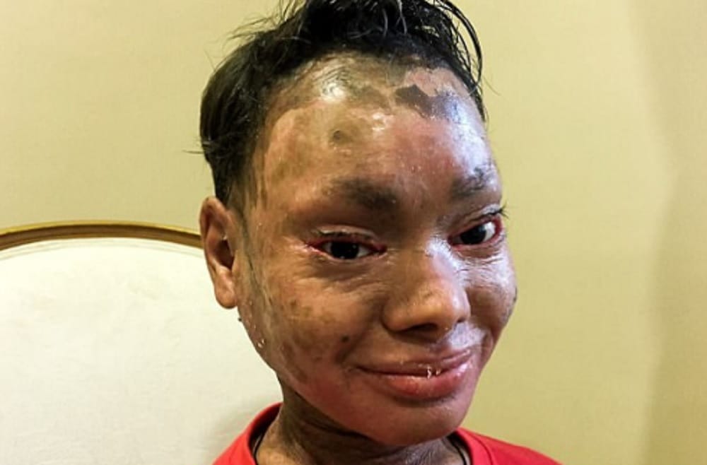 Indian snake girl suffering from rare skin disease 