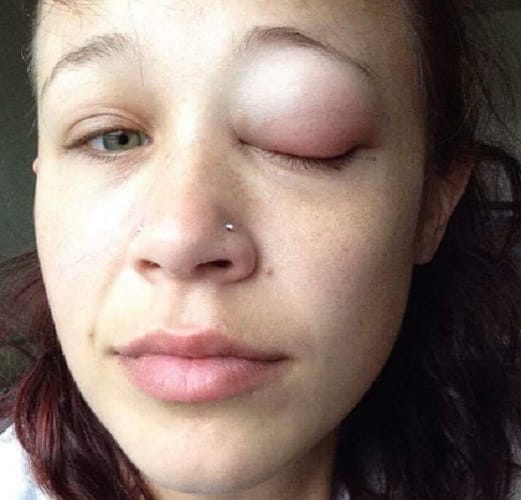Canadian model eye tattoo goes horribly wrong she lost her one eye