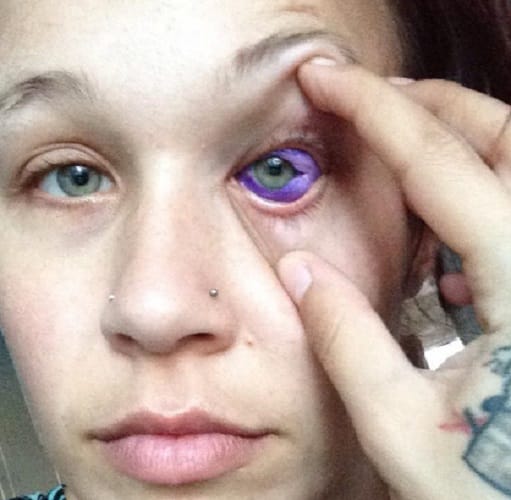 Canadian model eye tattoo goes horribly wrong she lost her one eye