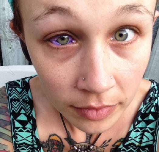 Canadian model eye tattoo goes horribly wrong she lost her one eye