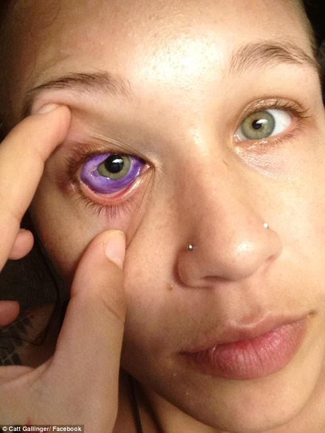 Canadian model eye tattoo goes horribly wrong she lost her one eye