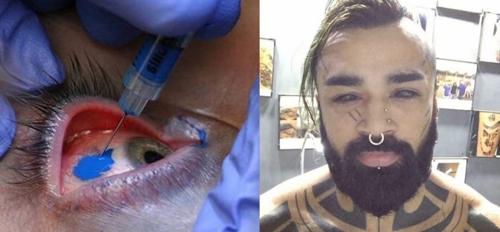 delhi man with tattoed eyeballs tells risk and dangers of it, he had always wanted to have it