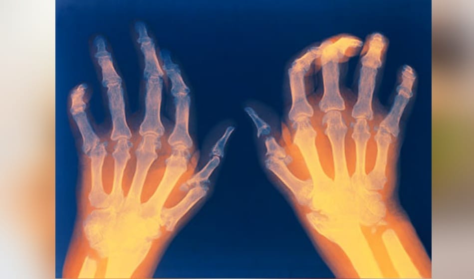 because of these reasons the number of Arthritis patients are increasing day by day