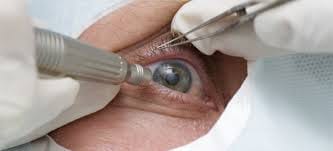 wrong eye operation in district hospital agra