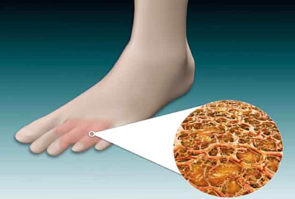 It can be dangerous for health to wear shoes without socks