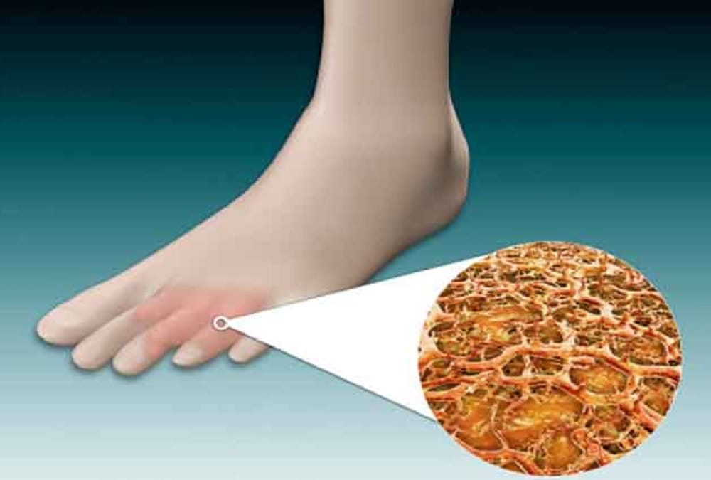 It can be dangerous for health to wear shoes without socks