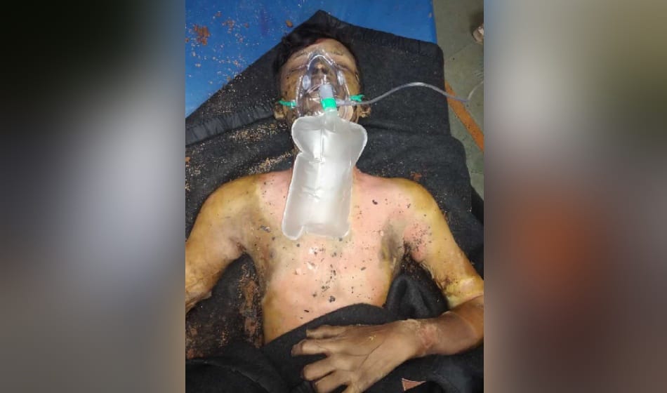 man who set himself on fire at india gate succumbed of injuries