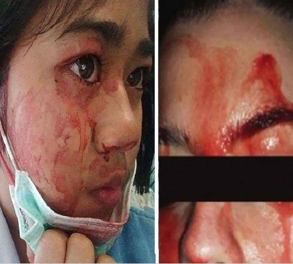 blood sweating of this woman from italy 