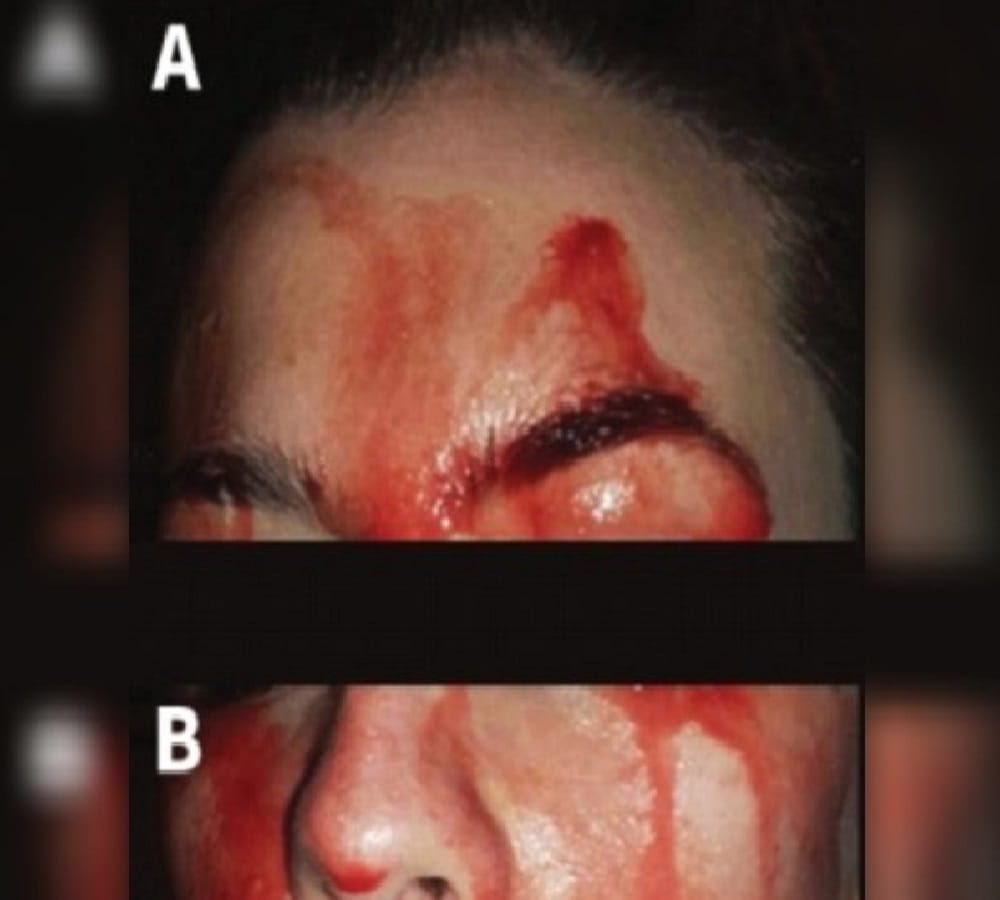 blood sweating of this woman from italy 