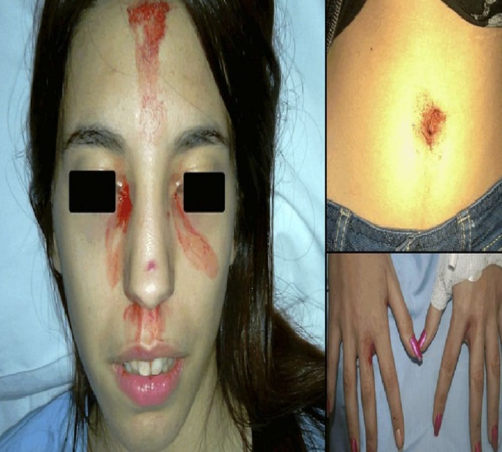 blood sweating of this woman from italy 