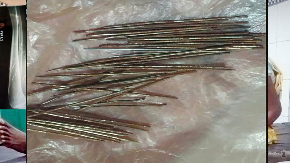 Iron nail Getting out from legs