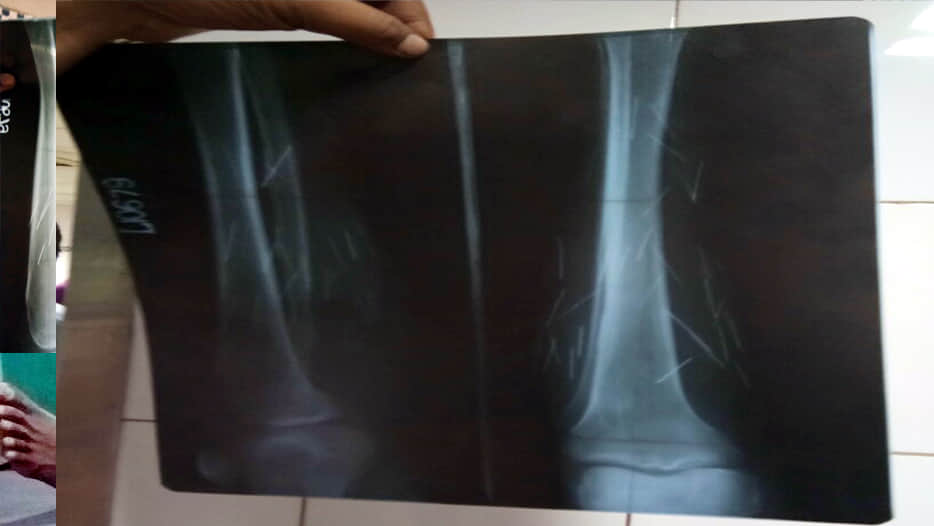 Iron nail Getting out from legs