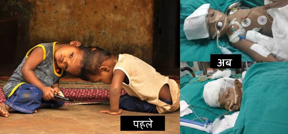 team of thirty doctor operated for thirty six hours to separate the two child who were born together