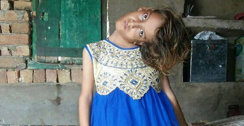 this Pakistani girl suffering from rare medical disorder neck bent into 90 degree angle 