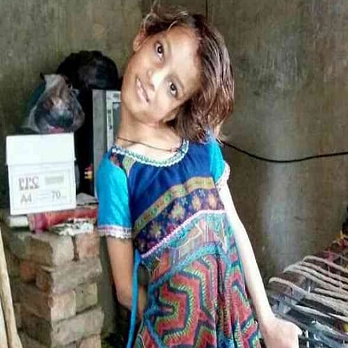 this Pakistani girl suffering from rare medical disorder neck bent into 90 degree angle 