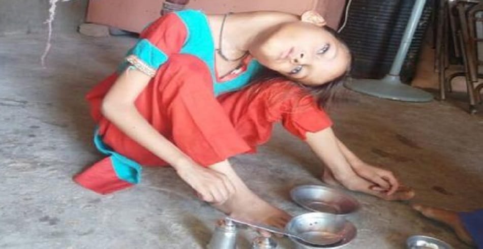 this Pakistani girl suffering from rare medical disorder neck bent into 90 degree angle 