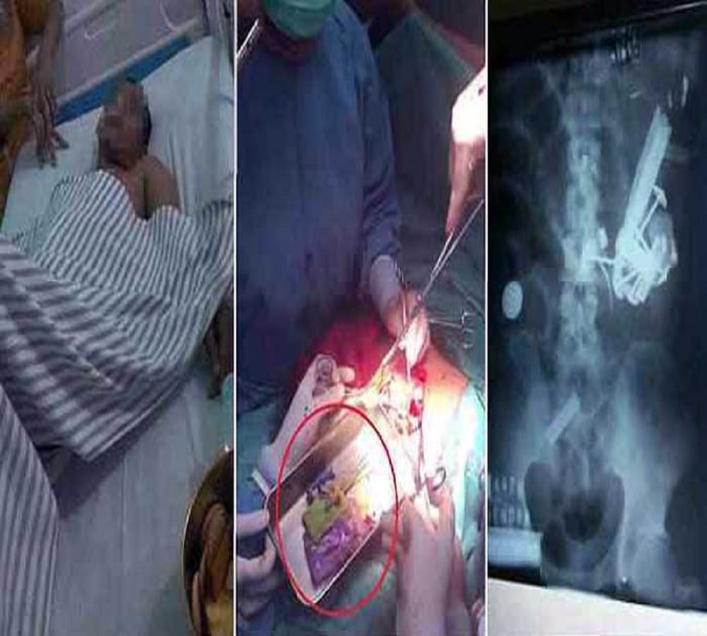 doctor shocked to found so many iron nails in patients stomach 