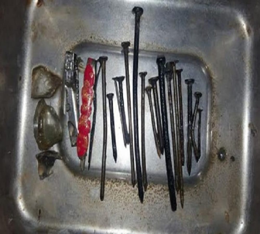 doctor shocked to found so many iron nails in patients stomach 