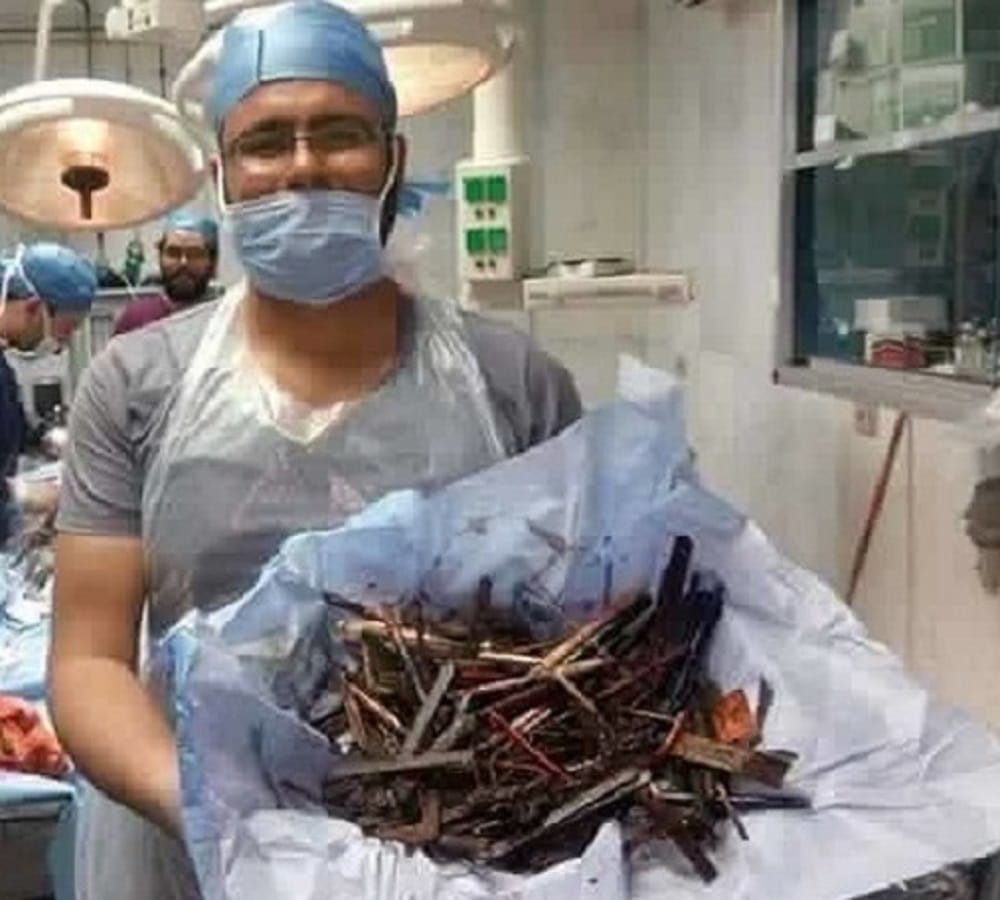 doctor shocked to found so many iron nails in patients stomach 
