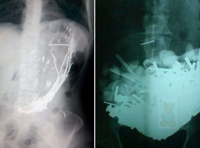 doctor shocked to found so many iron nails in patients stomach 