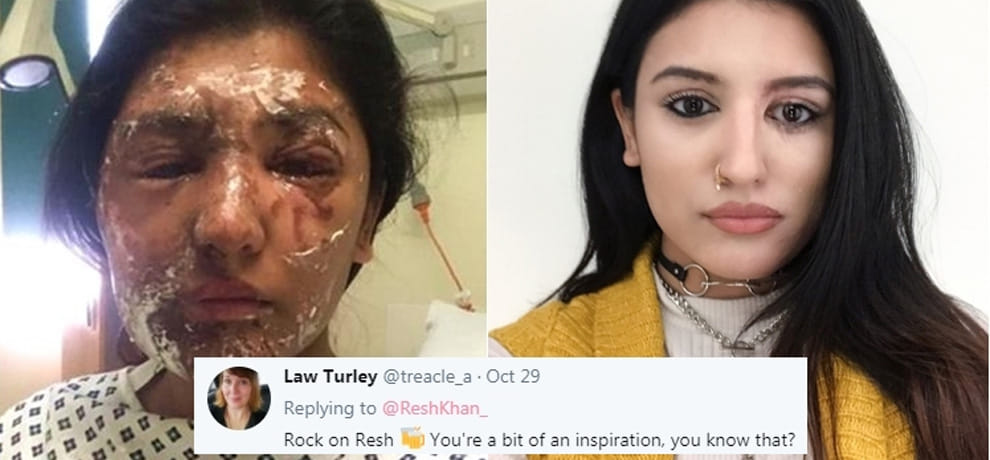 acid attack survivor and model shares her photos on social media
