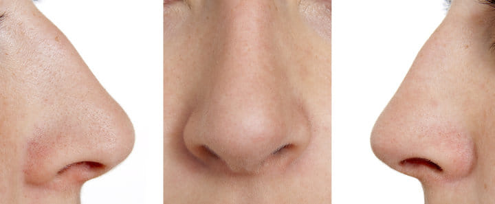 doctor make new nose from hip bone