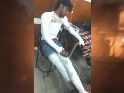 melted iron fell into factory worker at roorkee