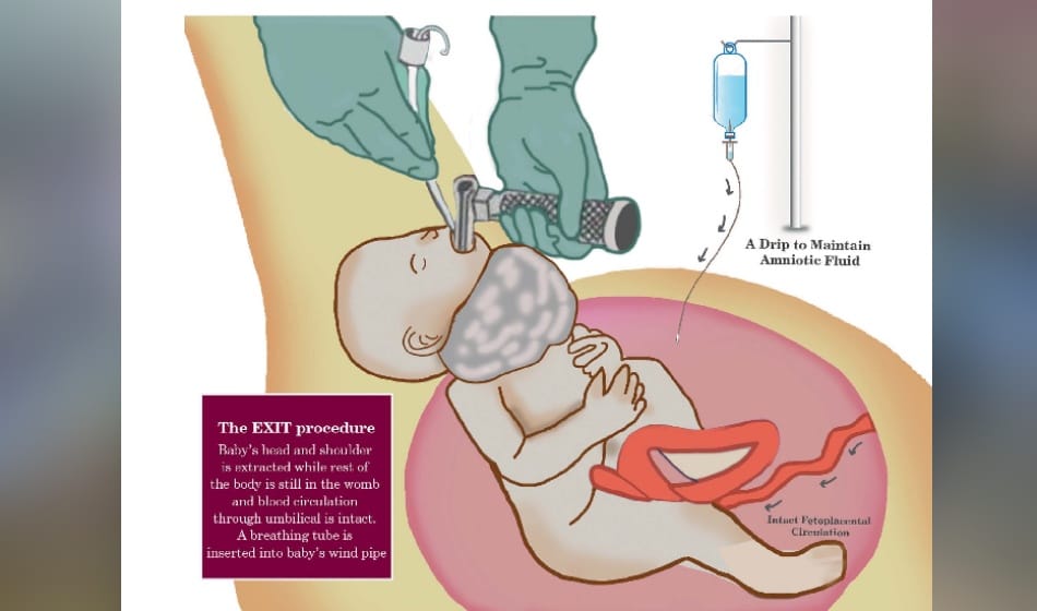 surgery of pregnant lady after delivering half body of the child