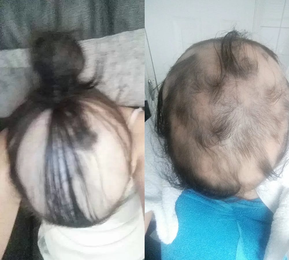 Woman claims her old relationship gave her Baldness