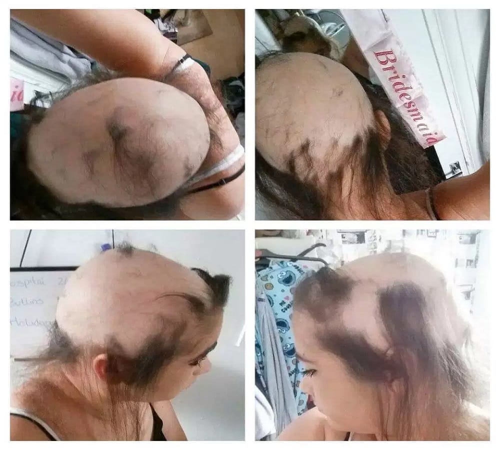 Woman claims her old relationship gave her Baldness