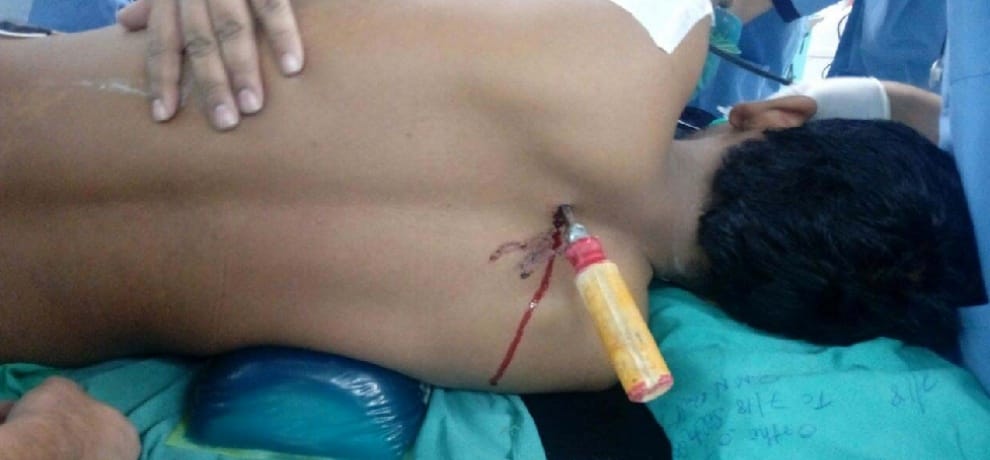 a big needle entered in a man's back, aiims doctors successful in removing it
