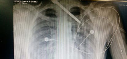 a big needle entered in a man's back, aiims doctors successful in removing it