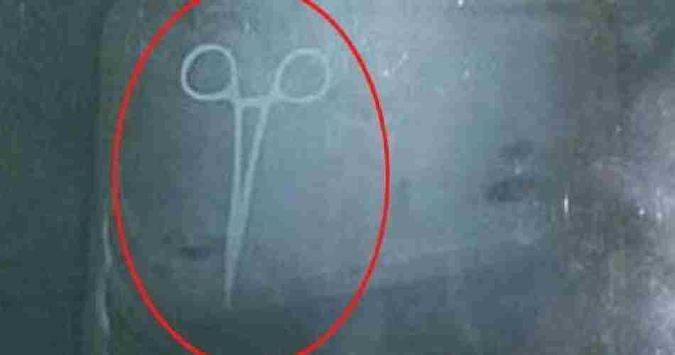 scissor found in stomach during operation at pgi chandigarh