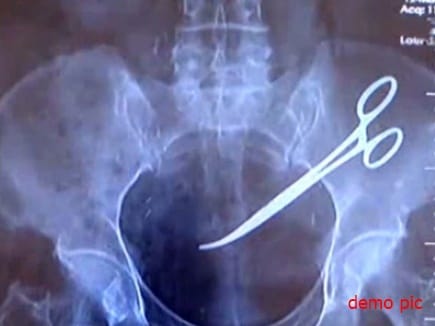 scissor found in stomach during operation at pgi chandigarh