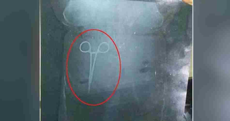 scissor found in stomach during operation at pgi chandigarh