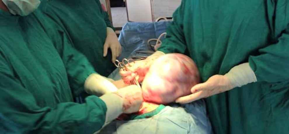 Himachal Mandi 6 kg tumour removed from woman stomach