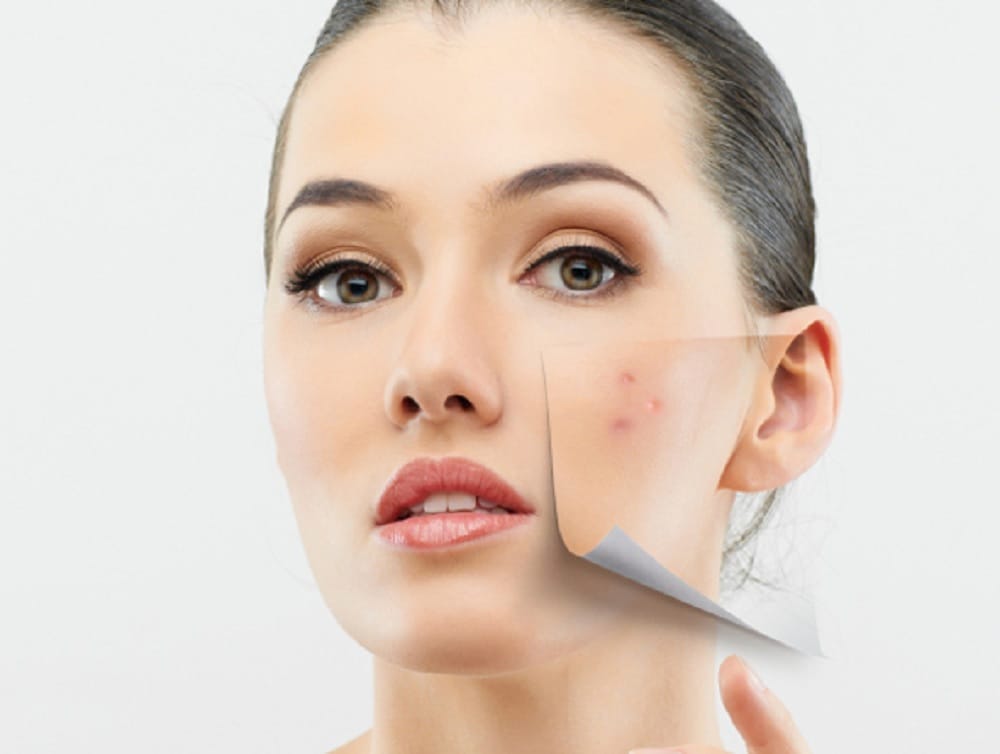 get rid of pimples patch with in one week with this turmeric remedy