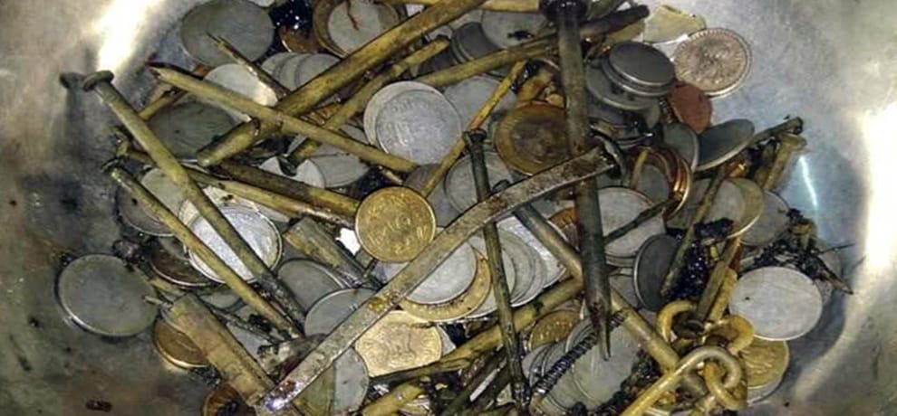 Madhya Pradesh Man swallowed 263 Coins Shaving Blades Needles