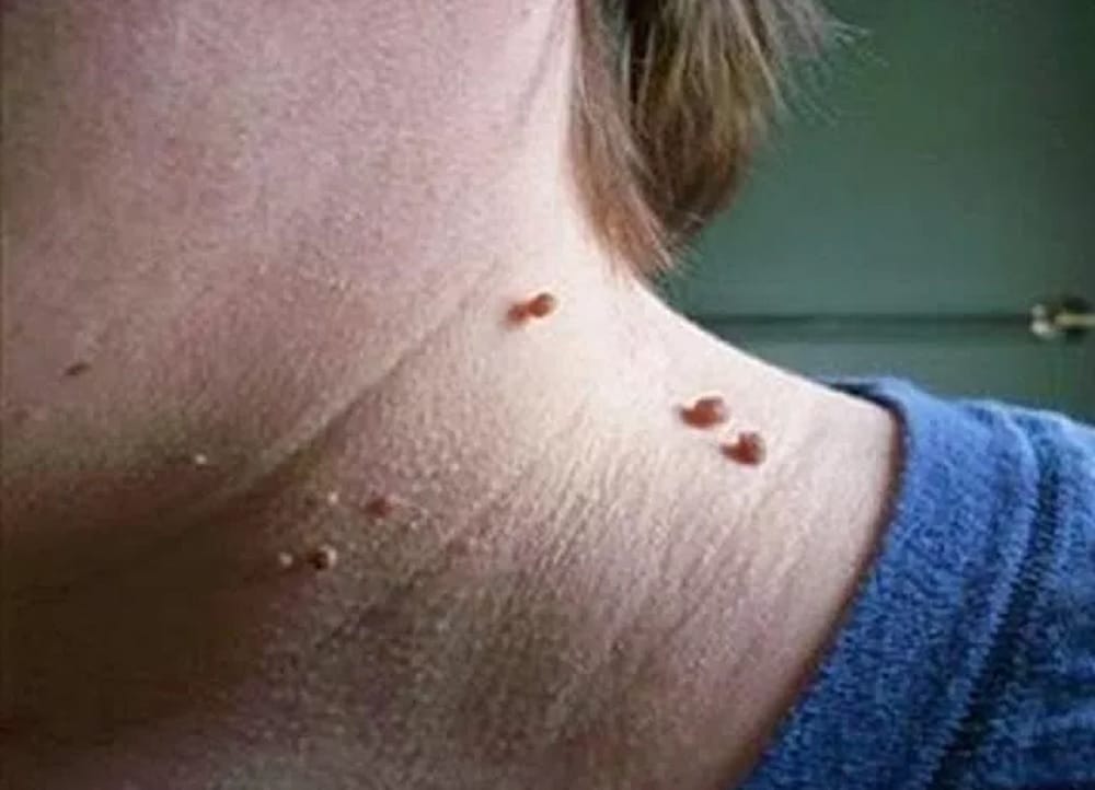 If Wart on your face troubles you alot then take the help of banana 