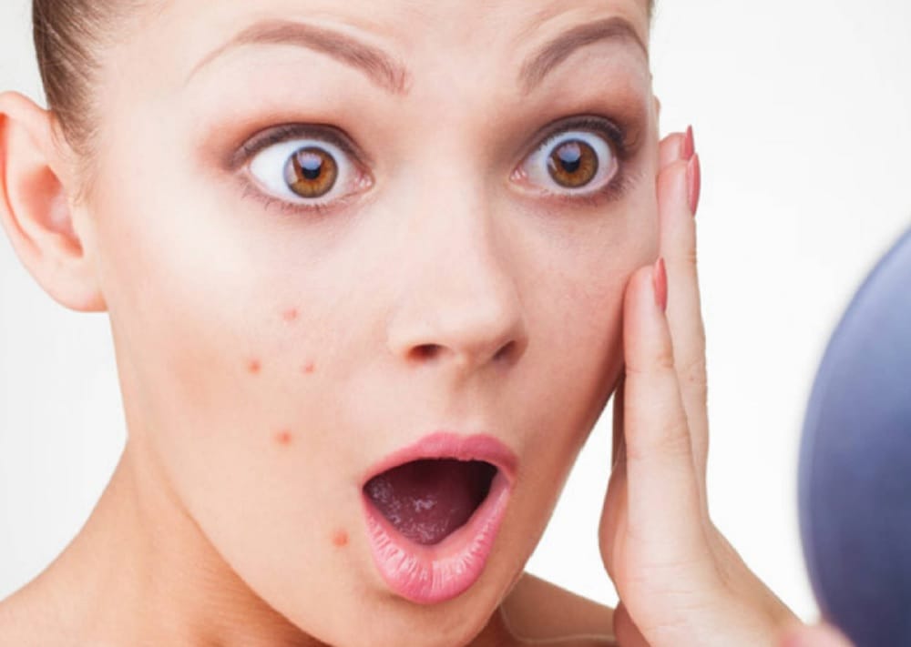 get rid of pimples patch with in one week with this turmeric remedy