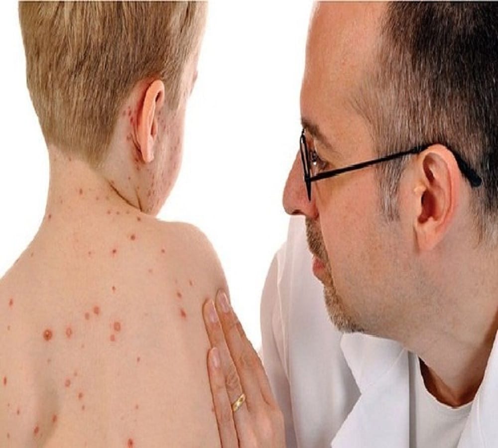 Do you know the reason why Chicken Pox called Mata in india